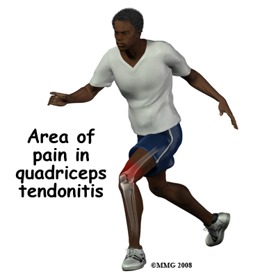 knee_tendonitis_quadriceps_symptom01