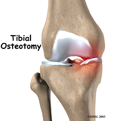 knee_tibosteo_intro01