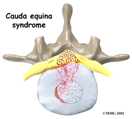 low_back_pain_symptom01