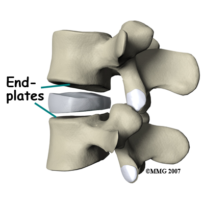 lumbar_ADR_anatomy03