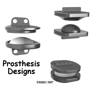 lumbar_ADR_prosthesis
