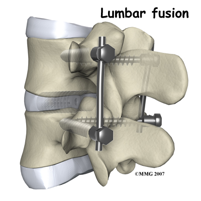 lumbar_ADR_rationale01 | Central Orthopedic Group