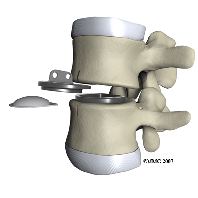 lumbar_ADR_surgery02