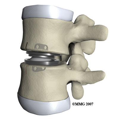 lumbar_ADR_surgery03