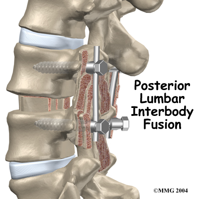 lumbar_PLIF_intro01