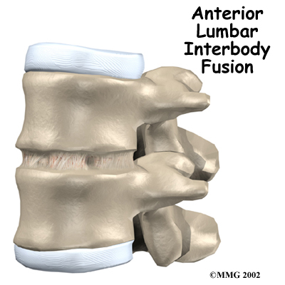 lumbar_anterior_fusion_intro01