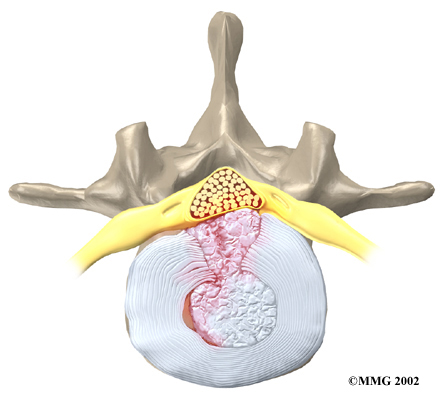 lumbar_anterior_fusion_rationale02