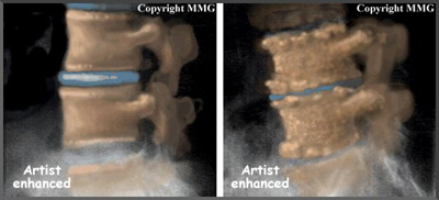 lumbar_degeneration_cause02