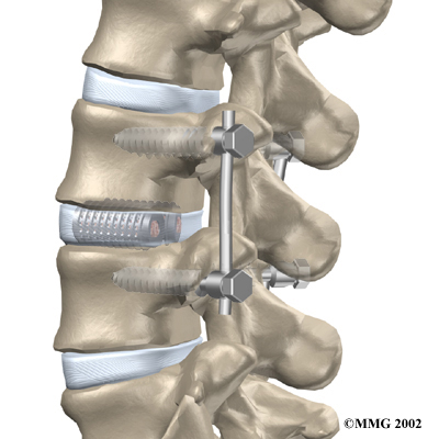 lumbar_degeneration_surgery05