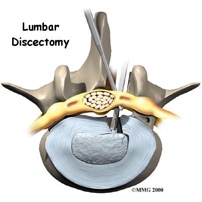 lumbar_discectomy_intro01