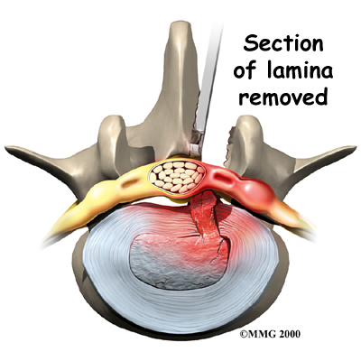 lumbar_discectomy_surgery01