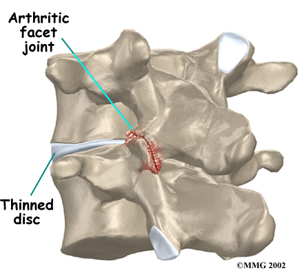 lumbar_facet_arthritis_cause01