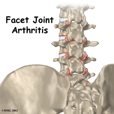lumbar_facet_arthritis_intro01