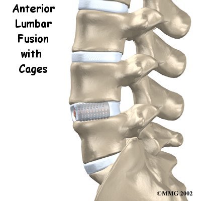 lumbar_fusion_cage_intro01