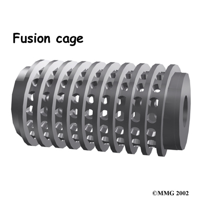 lumbar_fusion_cage_rationale03