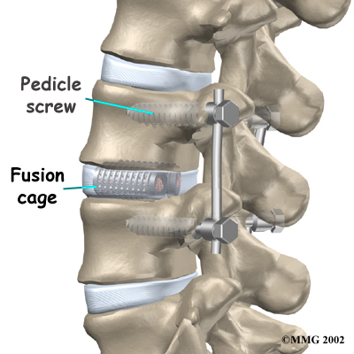 lumbar_fusion_cage_surgery03