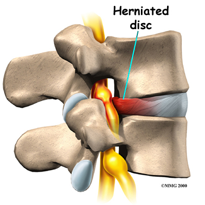 lumbar_herniation_cause02