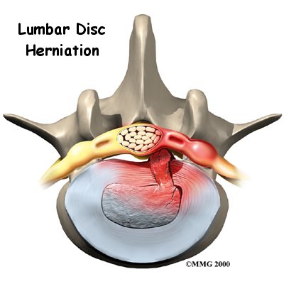 lumbar_herniation_intro01