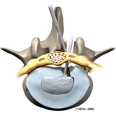 lumbar_herniation_surgery01