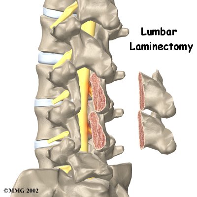 lumbar_laminectomy_intro01
