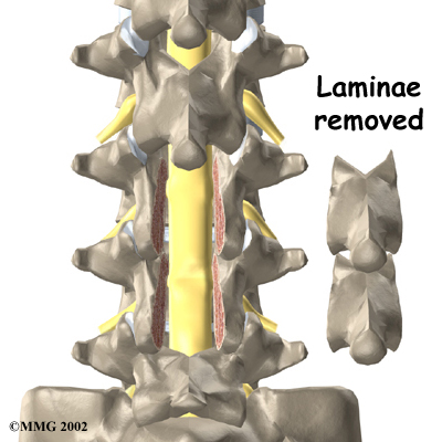 lumbar_laminectomy_surgery02