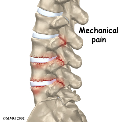 lumbar_posterior_fusion_rationale01