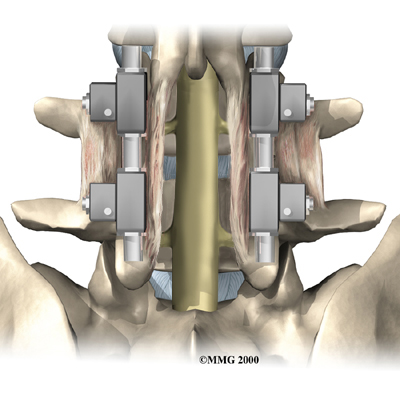 lumbar_posterior_fusion_surgery03
