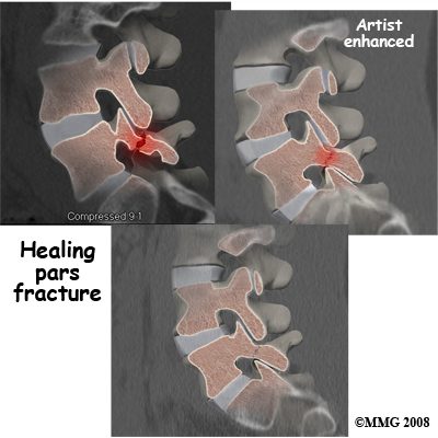 lumbar_spondylolisthesisCAT_Lumbar_Pars_Fx