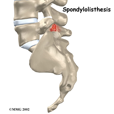 lumbar_spondylolisthesis_intro01