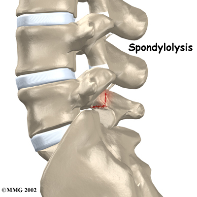 lumbar_spondylolysis_intro01