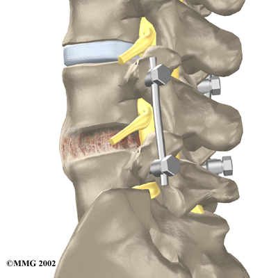 lumbar_stenosis_surgery03