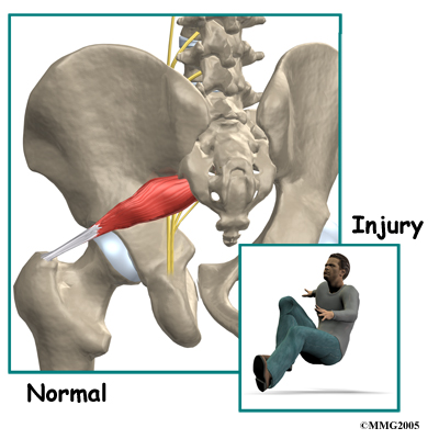 piriformis_cause01
