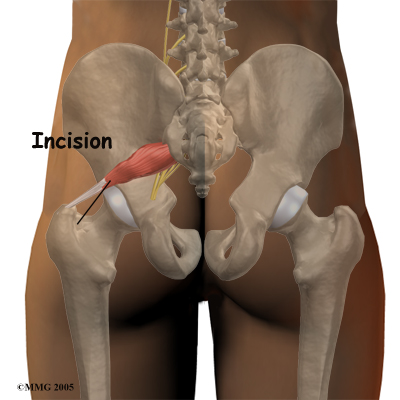 piriformis_surgery01