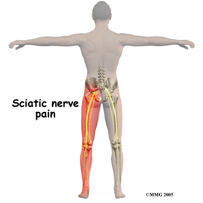 piriformis_symptoms01