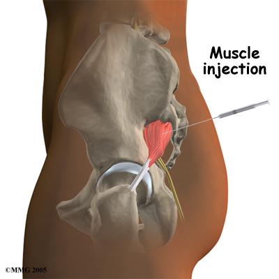piriformis_treatment01