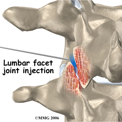 pm_general_fji_lumbar