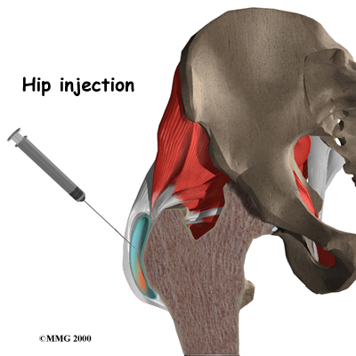 pm_general_inject_hip