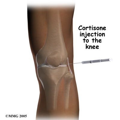 pm_general_inject_knee_cortisone