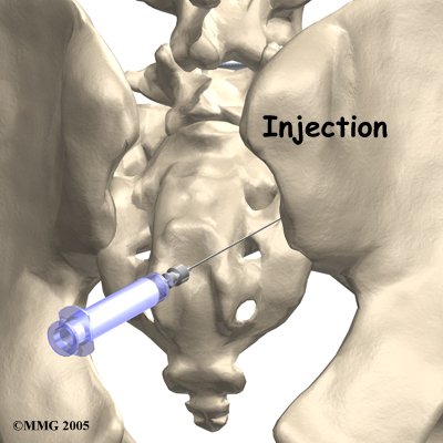 pm_si_joint_inj