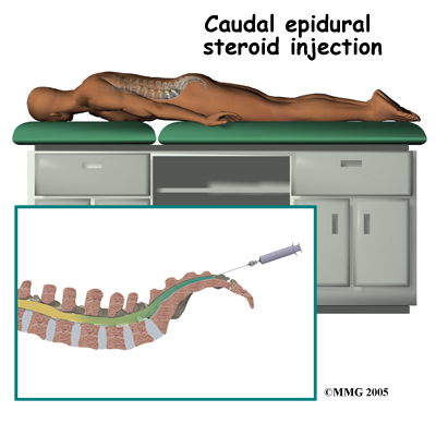 pmp_general_esi_caudal02