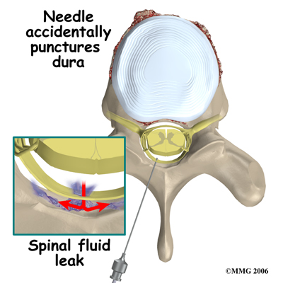 pmp_general_esi_complication