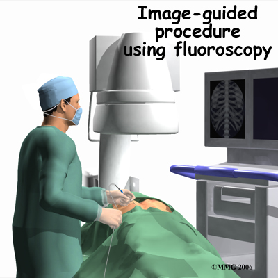rf_spine_procedure01