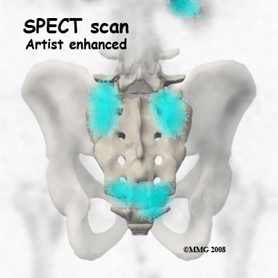 sacral_insufficiency_SPECT02