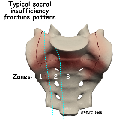 sacral_insufficiency_anatomy03