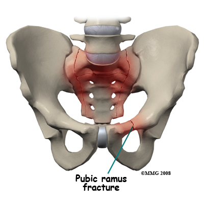 sacral_insufficiency_cause02