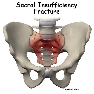 sacral_insufficiency_intro01