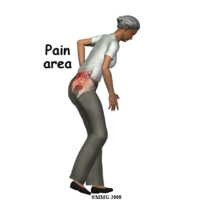sacral_insufficiency_symptom01