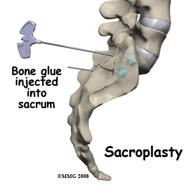 sacral_insufficiency_treatment01