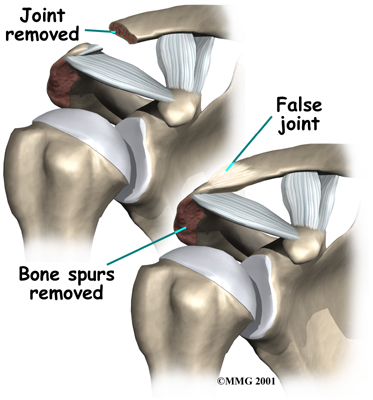 shoulder_acromioclavicular_arthrosis_surgery01