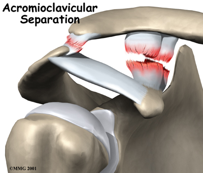 shoulder_acromioclavicular_separation_intro01